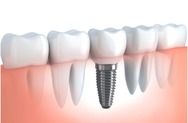 Best Dental Clinic Chennai